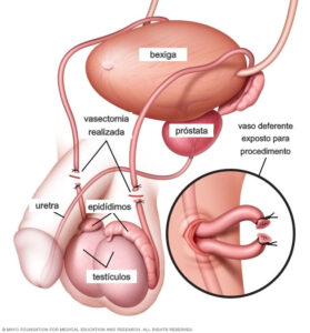 vasectomia-dr-andres